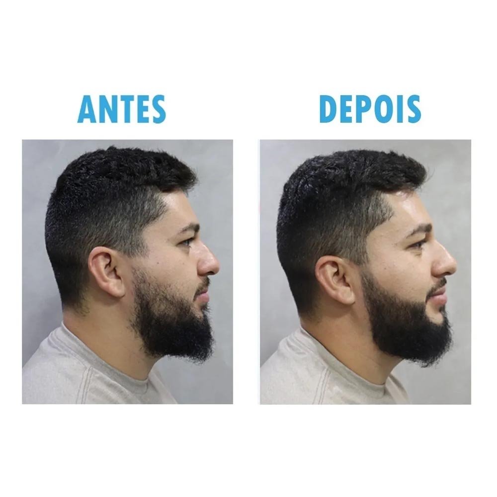 antes e depois preenchedor barba